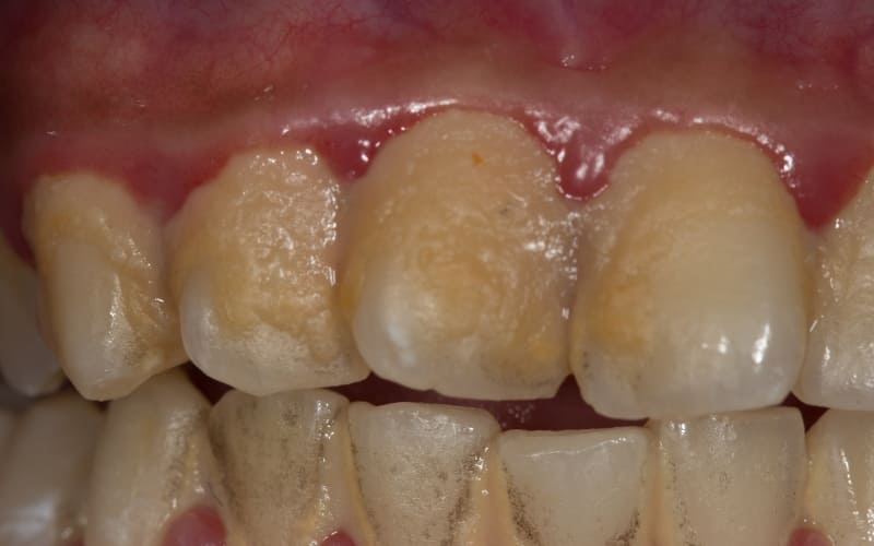 Natural ways to remove dental plaque at home